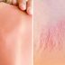 Heat Rash or Sunburn: Here’s How to Tell the Difference
