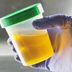 Expert Doctors: A Non-Invasive Urine Test Just “Changed the Game” for Prostate Screening